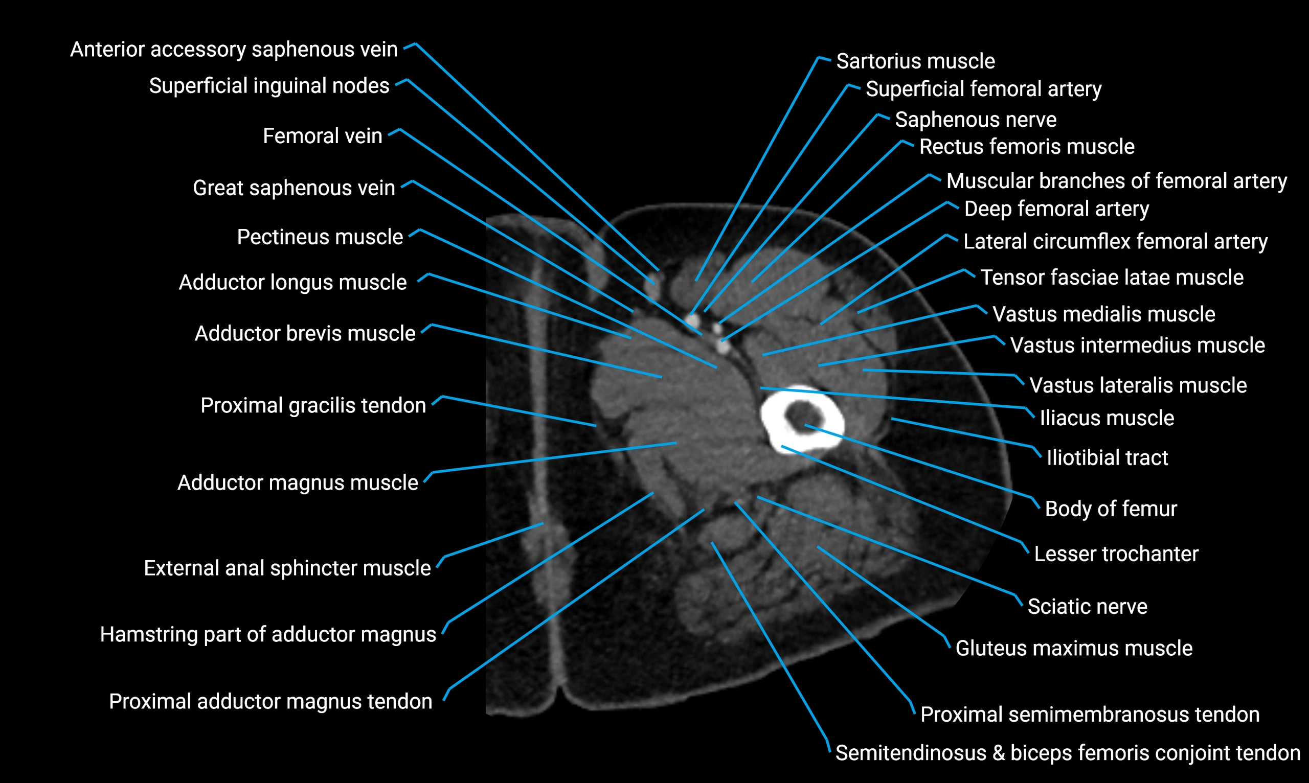 CT lower limb axial cross sectional anatomy labelled image 21 (2).webp